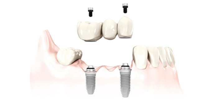 Dental Implant Bridge