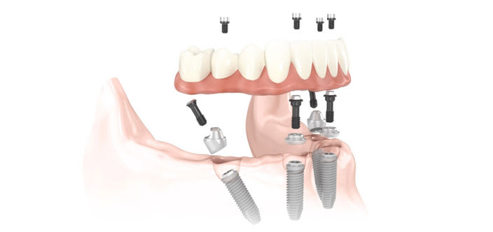 Implant Supported Bridge