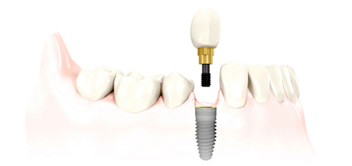 Single Dental Implant